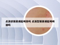 点滴状银屑病能喝茶吗 点滴型银屑病能喝啤酒吗