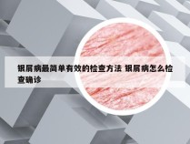 银屑病最简单有效的检查方法 银屑病怎么检查确诊