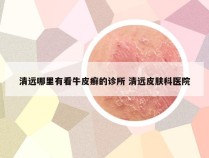 清远哪里有看牛皮癣的诊所 清远皮肤科医院