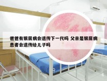 爸爸有银屑病会遗传下一代吗 父亲是银屑病患者会遗传给儿子吗
