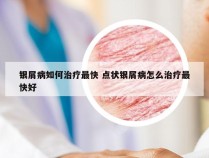 银屑病如何治疗最快 点状银屑病怎么治疗最快好
