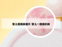 婴儿圈圈藓图片 婴儿一圈圈的藓