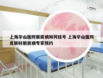 上海华山医院银屑病如何挂号 上海华山医院皮肤科银屑病专家预约