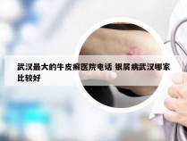 武汉最大的牛皮癣医院电话 银屑病武汉哪家比较好