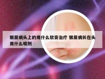 银屑病头上的用什么软膏治疗 银屑病长在头用什么喷剂