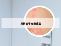 用粉底牛皮癣遮盖