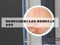 银屑病和水痘都是什么感染 银屑病和水土有关系吗