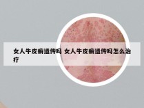 女人牛皮癣遗传吗 女人牛皮癣遗传吗怎么治疗