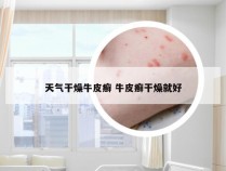 天气干燥牛皮癣 牛皮癣干燥就好