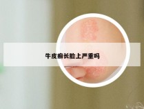 牛皮癣长脸上严重吗