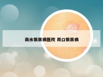 商水银屑病医院 周口银屑病