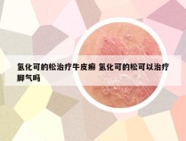 氢化可的松治疗牛皮癣 氢化可的松可以治疗脚气吗