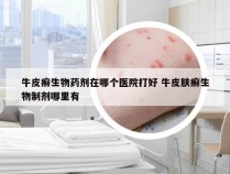牛皮癣生物药剂在哪个医院打好 牛皮肤癣生物制剂哪里有