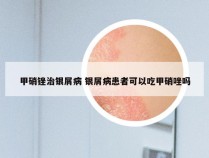 甲硝锉治银屑病 银屑病患者可以吃甲硝唑吗