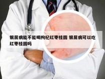 银屑病能不能喝枸杞红枣桂圆 银屑病可以吃红枣桂圆吗