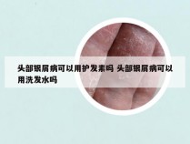 头部银屑病可以用护发素吗 头部银屑病可以用洗发水吗