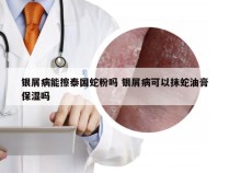 银屑病能擦泰国蛇粉吗 银屑病可以抹蛇油膏保湿吗