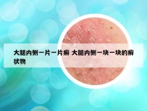大腿内侧一片一片癣 大腿内侧一块一块的癣状物