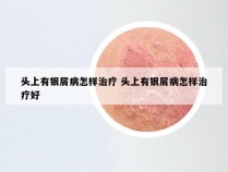 头上有银屑病怎样治疗 头上有银屑病怎样治疗好