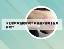 河北银屑病医院哪家好 银屑病河北哪个医院看的好
