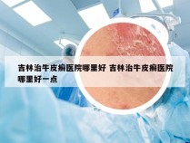 吉林治牛皮癣医院哪里好 吉林治牛皮癣医院哪里好一点
