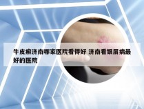 牛皮癣济南哪家医院看得好 济南看银屑病最好的医院