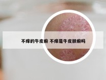 不痒的牛皮癣 不痒是牛皮肤癣吗