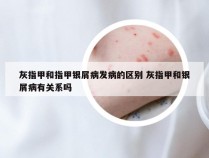 灰指甲和指甲银屑病发病的区别 灰指甲和银屑病有关系吗