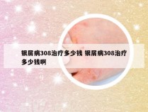 银屑病308治疗多少钱 银屑病308治疗多少钱啊