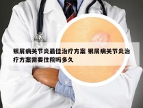 银屑病关节炎最佳治疗方案 银屑病关节炎治疗方案需要住院吗多久