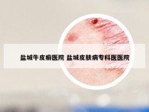盐城牛皮癣医院 盐城皮肤病专科医医院