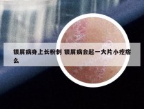 银屑病身上长粉刺 银屑病会起一大片小疙瘩么