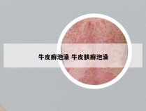 牛皮癣泡澡 牛皮肤癣泡澡