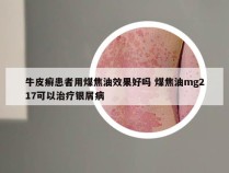 牛皮癣患者用煤焦油效果好吗 煤焦油mg217可以治疗银屑病