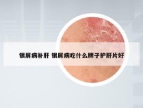 银屑病补肝 银屑病吃什么牌子护肝片好