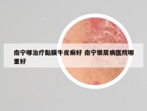 南宁哪治疗黏膜牛皮癣好 南宁银屑病医院哪里好