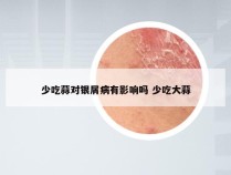 少吃蒜对银屑病有影响吗 少吃大蒜