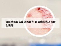 银屑病长在头皮上怎么办 银屑病在头上有什么表现