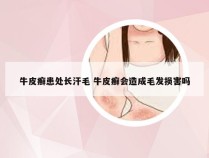 牛皮癣患处长汗毛 牛皮癣会造成毛发损害吗
