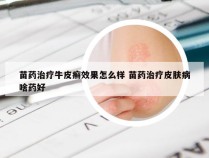 苗药治疗牛皮癣效果怎么样 苗药治疗皮肤病啥药好