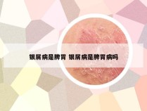 银屑病是脾胃 银屑病是脾胃病吗