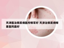 天津医治银屑病医院哪家好 天津治银屑病哪里医院最好