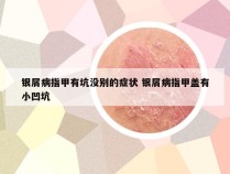 银屑病指甲有坑没别的症状 银屑病指甲盖有小凹坑