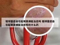 链球菌感染引起银屑病能治愈吗 链球菌感染引起银屑病能治愈吗吃什么药