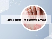 小孩银屑病初期 小孩银屑病初期治疗方法