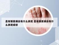 患有银屑病会有什么表现 患有银屑病会有什么表现症状