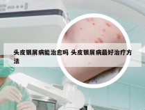 头皮银屑病能治愈吗 头皮银屑病最好治疗方法