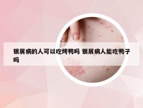 银屑病的人可以吃烤鸭吗 银屑病人能吃鸭子吗