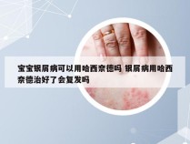 宝宝银屑病可以用哈西奈德吗 银屑病用哈西奈德治好了会复发吗