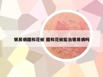 银屑病醋和花椒 醋和花椒能治银屑病吗